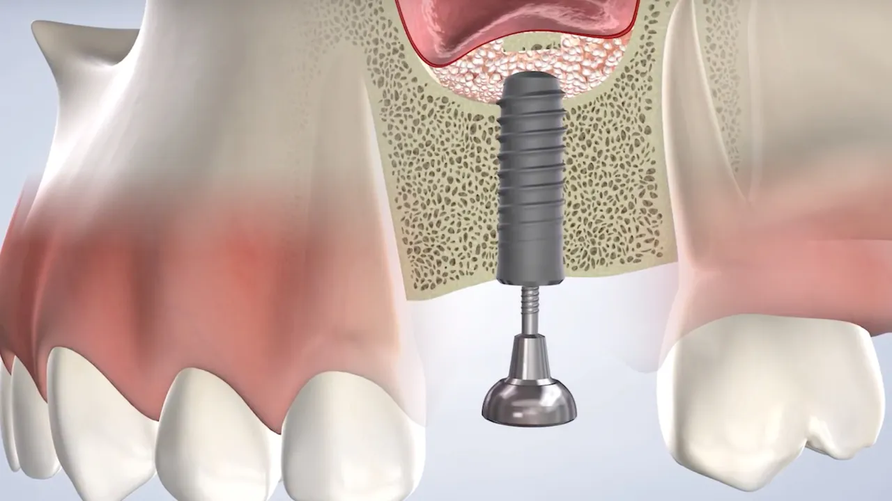 A bone graft supporting a dental implant