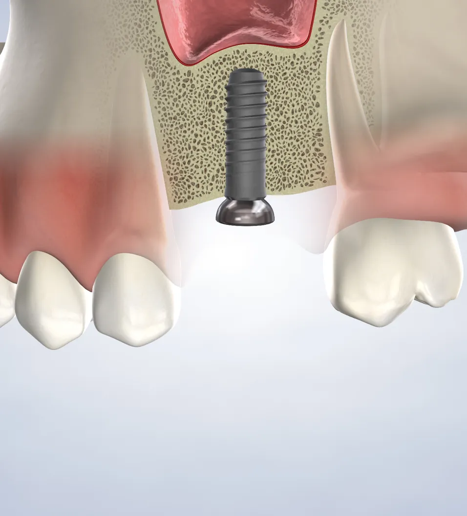 Procedure query page bone grafting