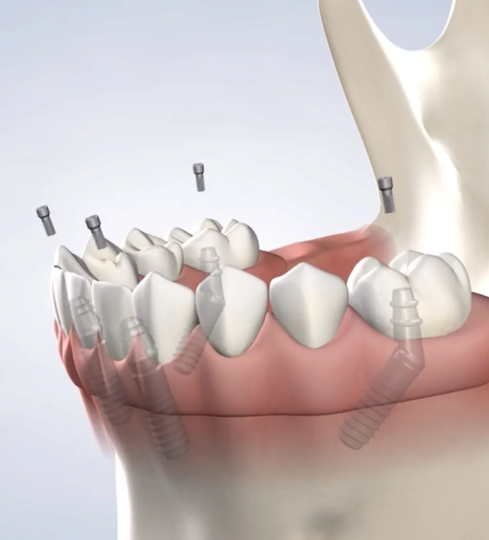 Procedure query page full arch restoration