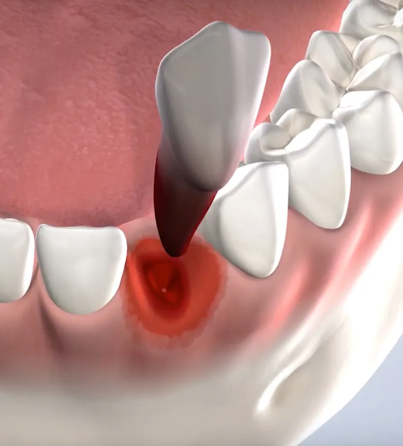 Procedure query page tooth extraction