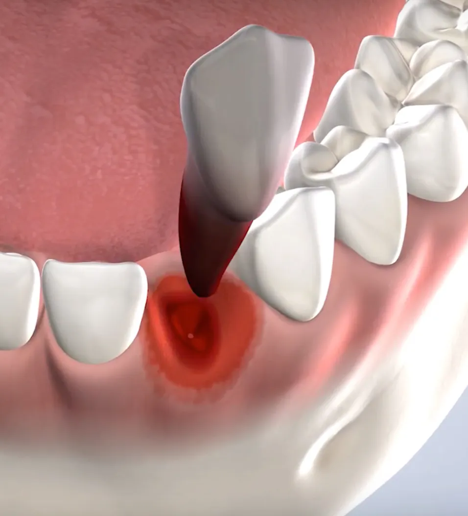 Procedure query page tooth extraction