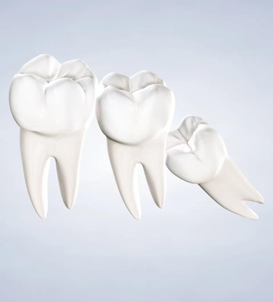 Procedure query page wisdom teeth removal